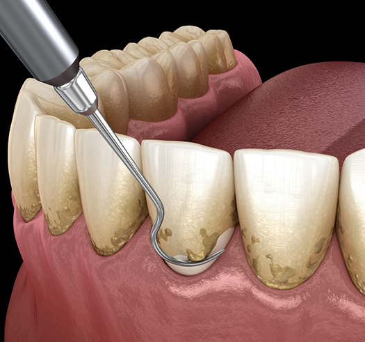 Illustration of a dental scaler clearing tartar buildup from the teeth and gums