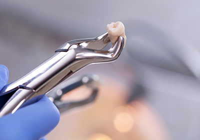 Dental forceps holding an extracted tooth