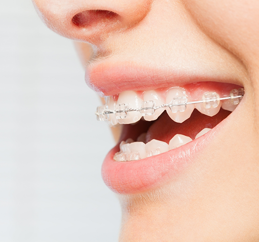 Close up of a smile with braces